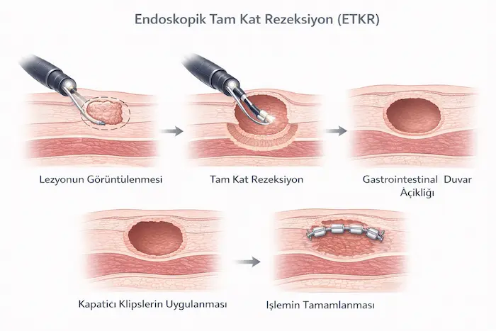 endoskopik tam kat rezeksiyon eftr asamalari