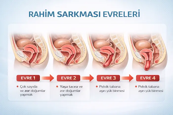 Rahim Sarkması Evreleri