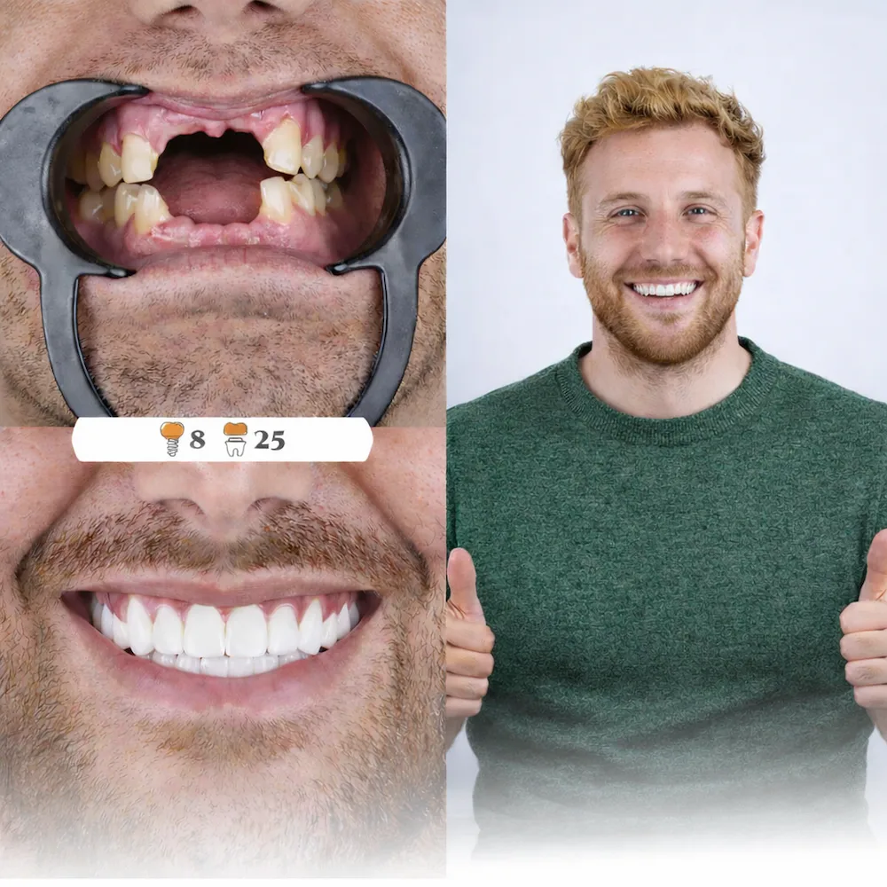 dental implant turkey